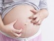 גירודים בהריון - למה זה קורה וכיצד ניתן להקל