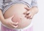 גירודים בהריון - למה זה קורה וכיצד ניתן להקל