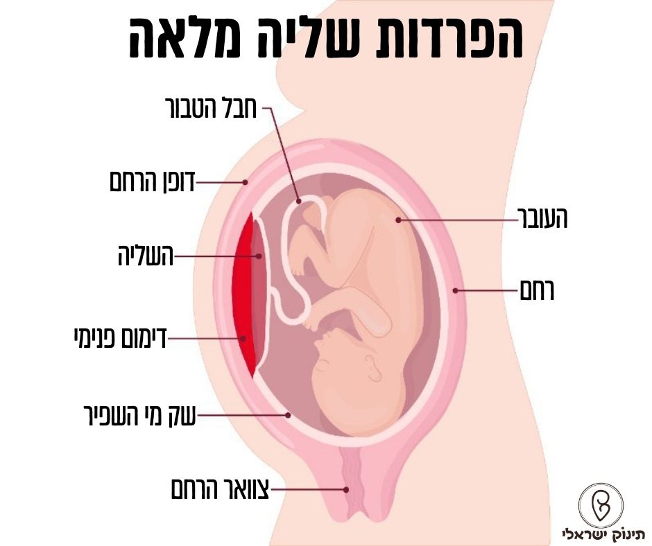 הפרדות שליה מלאה