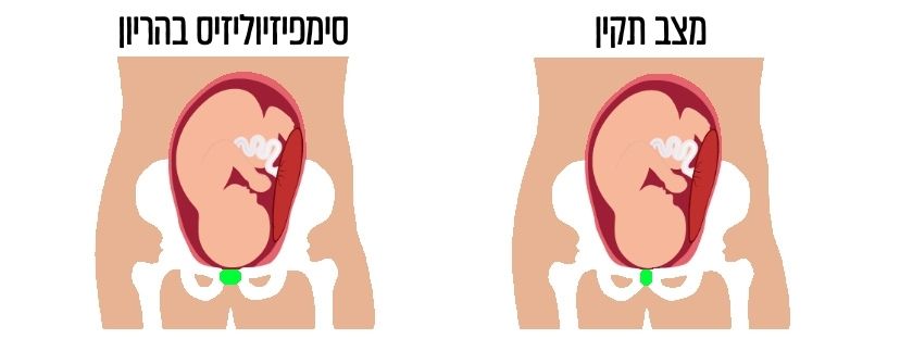 סימפיזיוליזיס בהריון