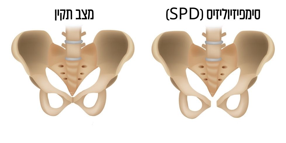 כאבים באגן בהריון