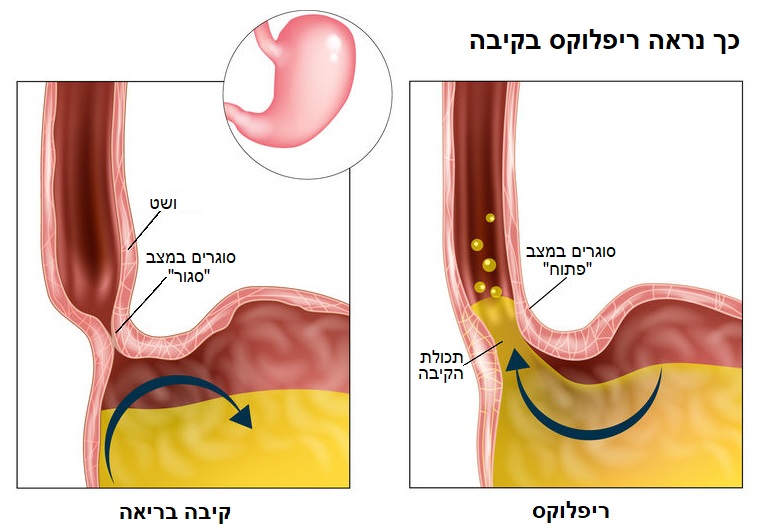 ריפלוקס אצל תינוקות