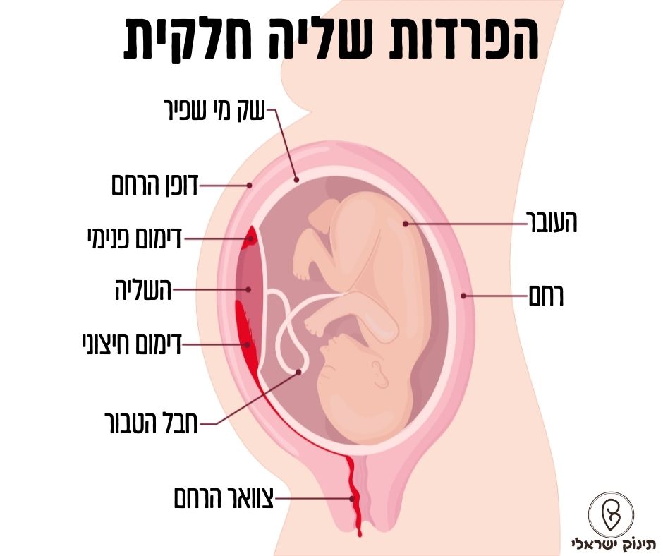 הפרדות שליה חלקית