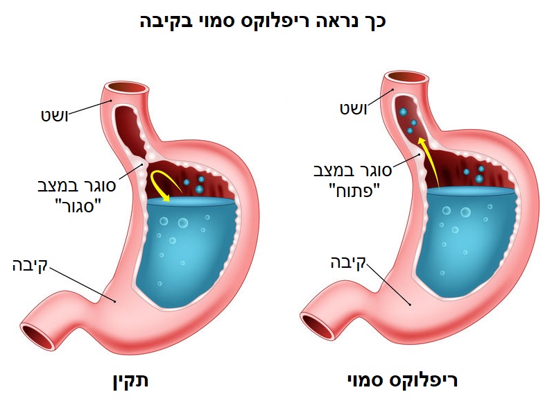 ריפלוקס סמוי אצל תינוקות